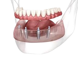image of all on 4 dental implants to help patients understand procedure