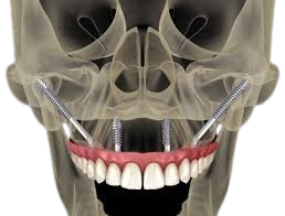 image of zygomatic implants