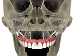 image of zygomatic implants