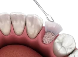 image of a dental bone graft for patients to understand the process