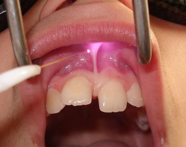 image of a child who is having a frenectomy