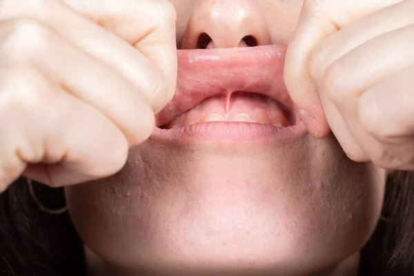 picture of a person showing the frenulum between their gums and their upper lips before oral surgery