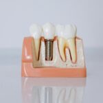 image of dental implant model, with two normal teeth either side.