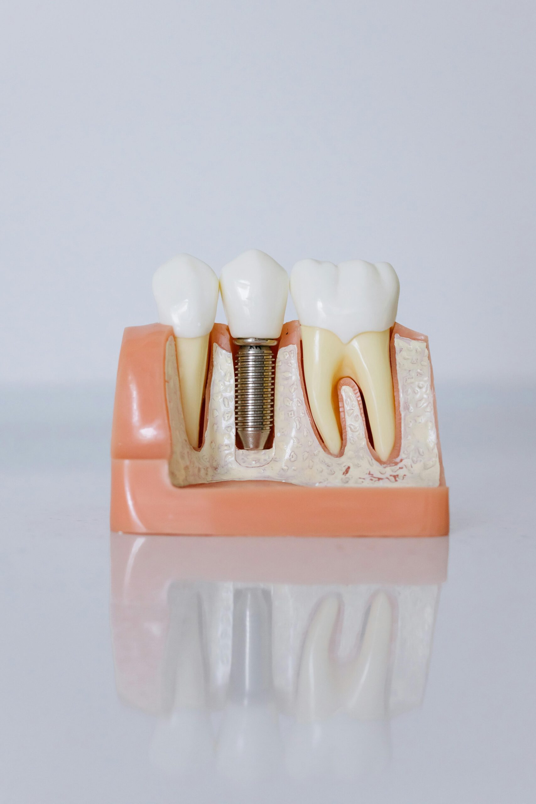 image of dental implant model, with two normal teeth either side.