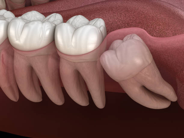 picture of wisdom tooth impaction requiring private ex