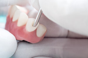 picture of tooth being prepped for a dental bone graft