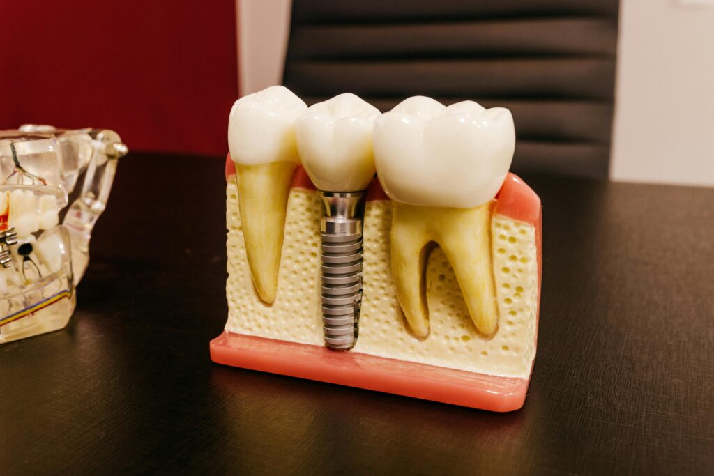 image of a dental implant to help explain how long dental implants last