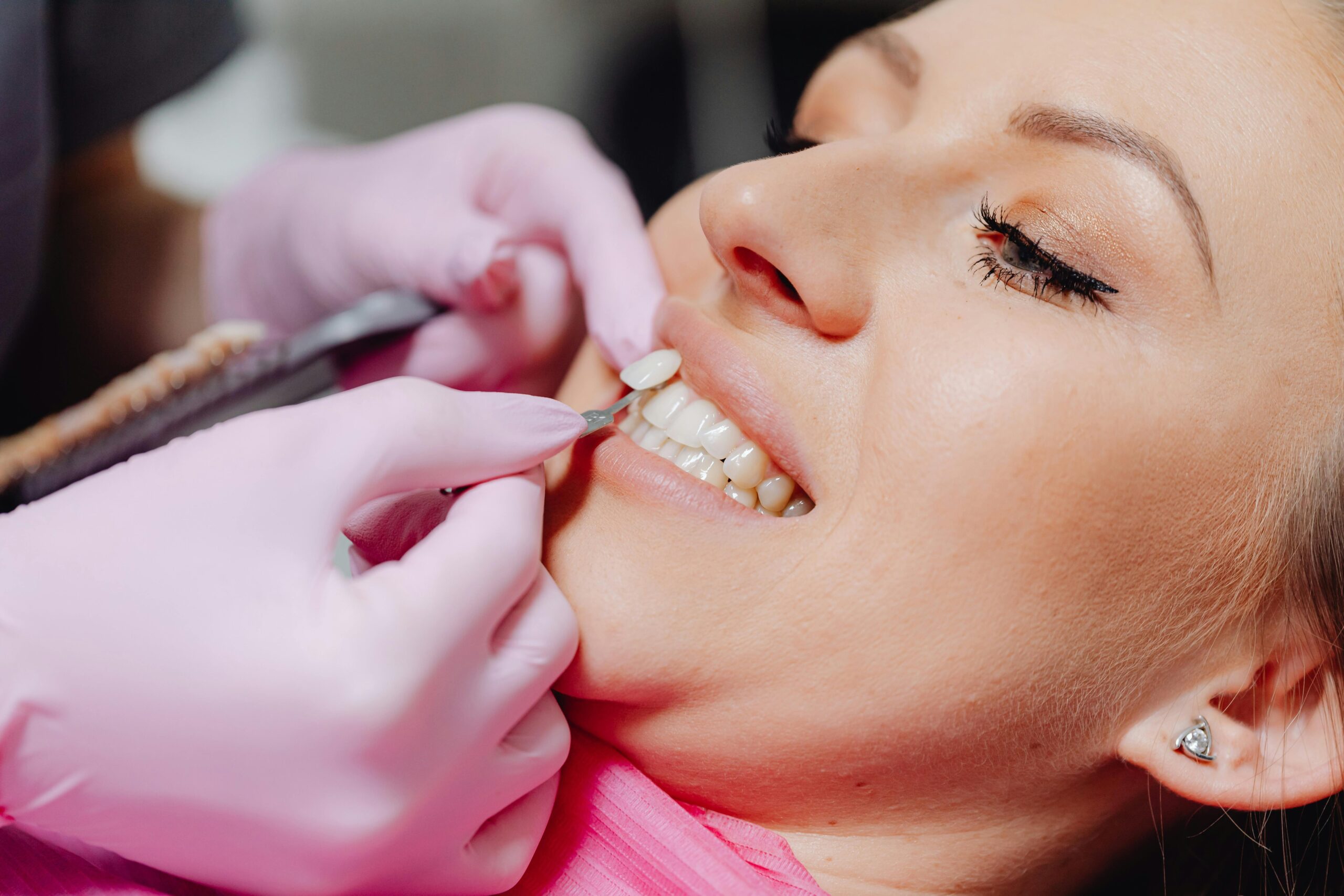 A Dentist Applying a Veneer Tooth on a Patient