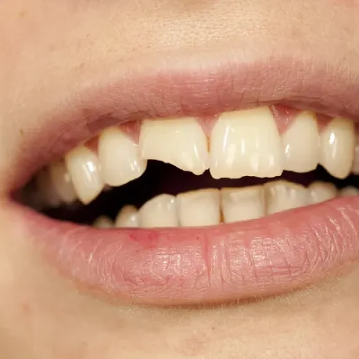 depositphotos_35443709-stock-photo-broken-tooth