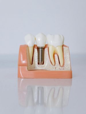 image of dental implant model, with two normal teeth either side.